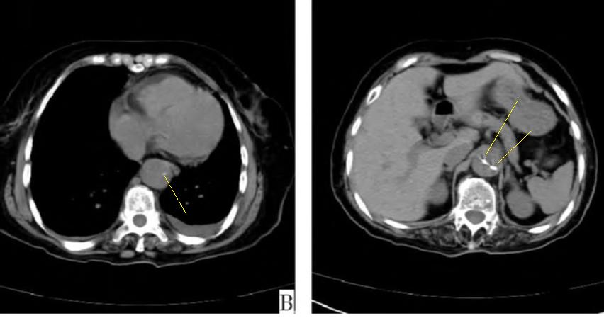如何监测动脉夹层早期,动脉增强ct能查出主动脉夹层么