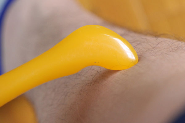 手臂刮出来好多红痧是毒素吗,刮痧刮出的疙瘩是湿气还是毒素