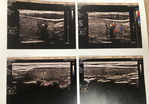 「人民好医声29」肿瘤拦不住换肾路，跋涉千里终得治