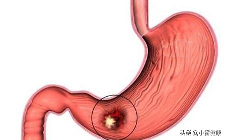 反复发热有可能是肿瘤吗,如何判断发热和肿瘤的关系