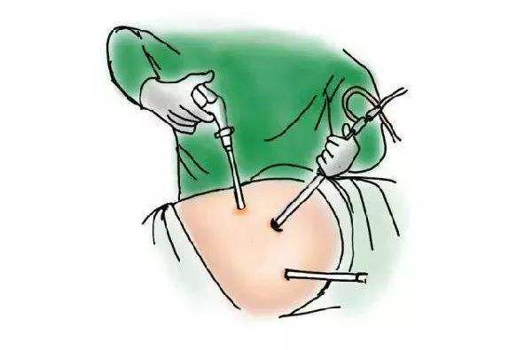 苏州科技城医院实施三例“高龄疑难腹腔镜右半结肠癌根治术”