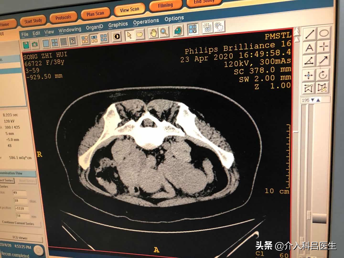 子宫腺肌症+巧囊很棘手？医生一根针，改变子宫内部环境