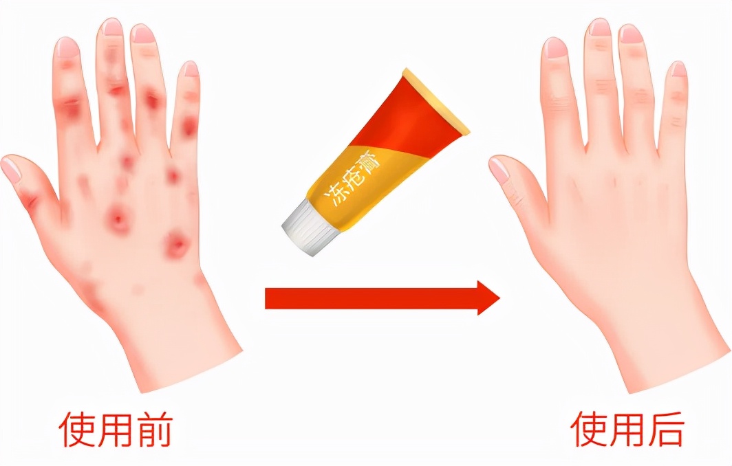 一到冬天就复发?小菌衣教你几招远离冻疮烦恼