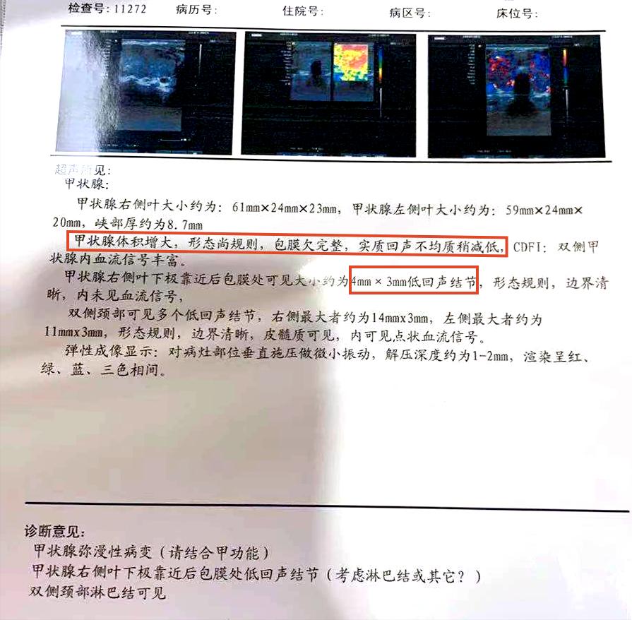 桥本甲亢和结节,桥本甲状腺炎出现轻微甲亢