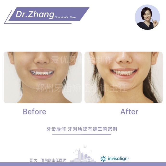 郑州矫正牙齿整形哪个医院好,郑州牙齿局部矫正