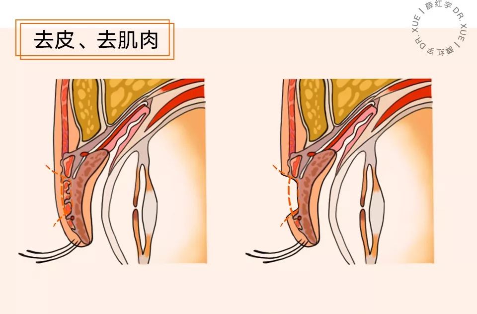 无痕双眼皮大概要多少钱,无痕双眼皮闭眼有痕