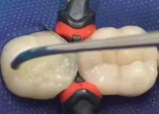 补牙4年后钻心的痛怎么回事,补牙一两年后出现疼痛什么原因