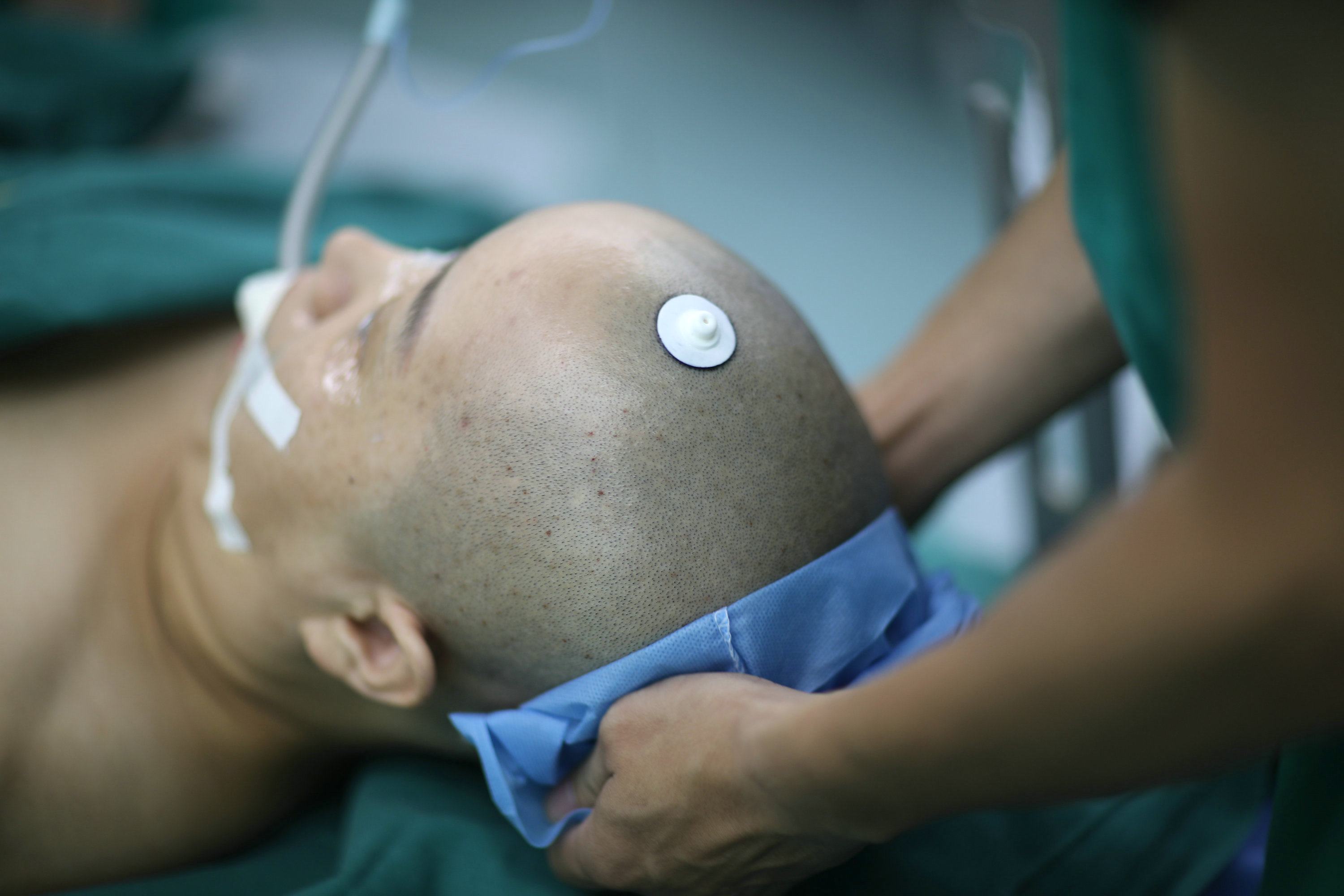 脑膜瘤开颅手术一般几小时,交通事故开颅手术定残程序