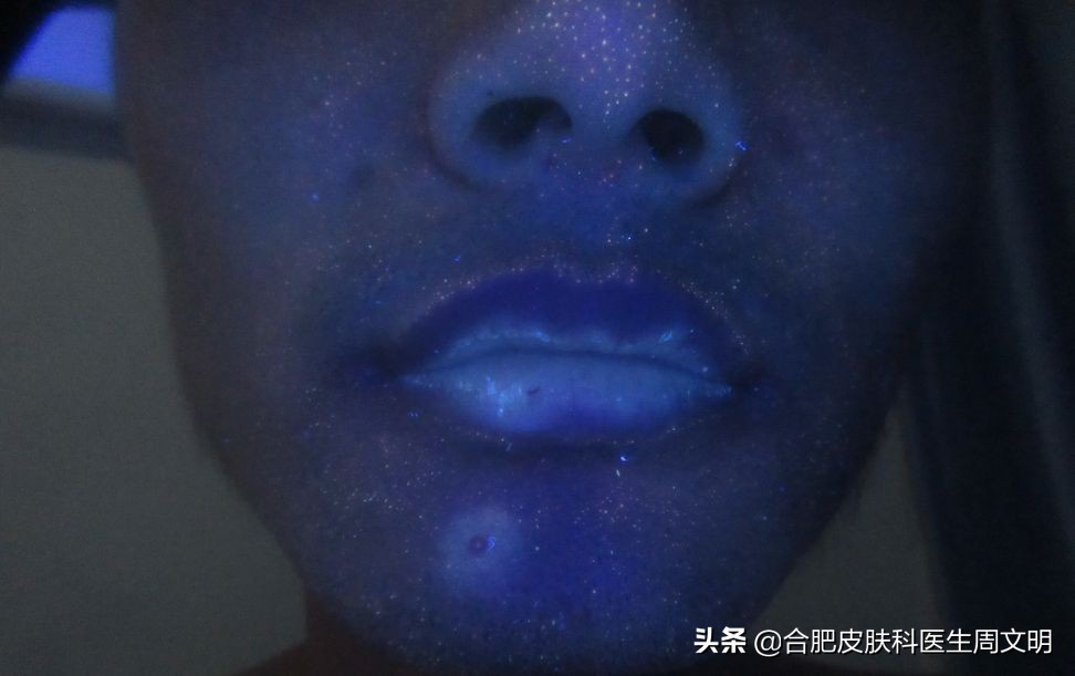 鍒湁姣涗細瀵艰嚧鐧界櫆椋庡悧,鍒湁姣涗細鍒垚鐧界櫆椋庡悧