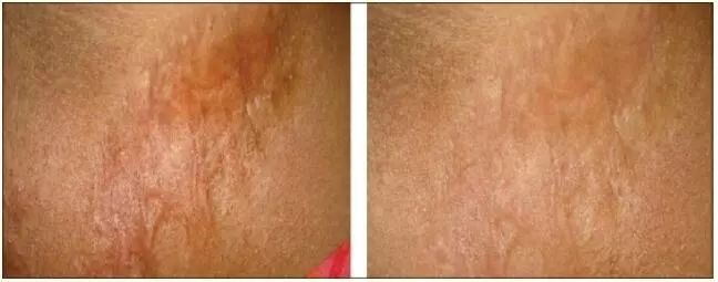 疤痕护理乳膏治疤痕可以吗,祛疤痕药有消炎效果吗