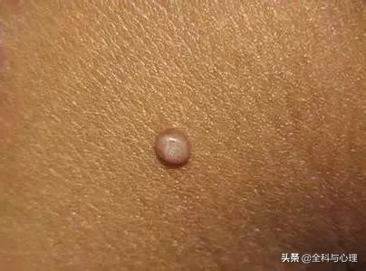 肛门突然有肿块怎么治疗最好,肛门里面有肿物有什么症状