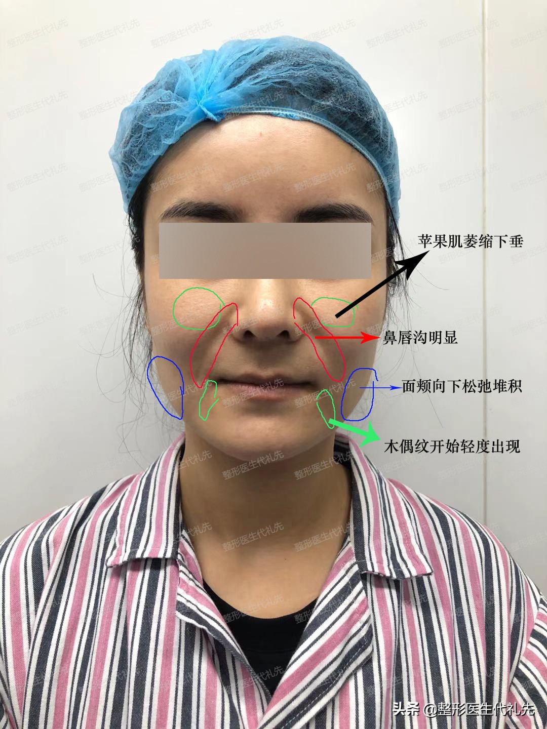 面部切皮提升手术,面部筋膜提升术和大拉皮