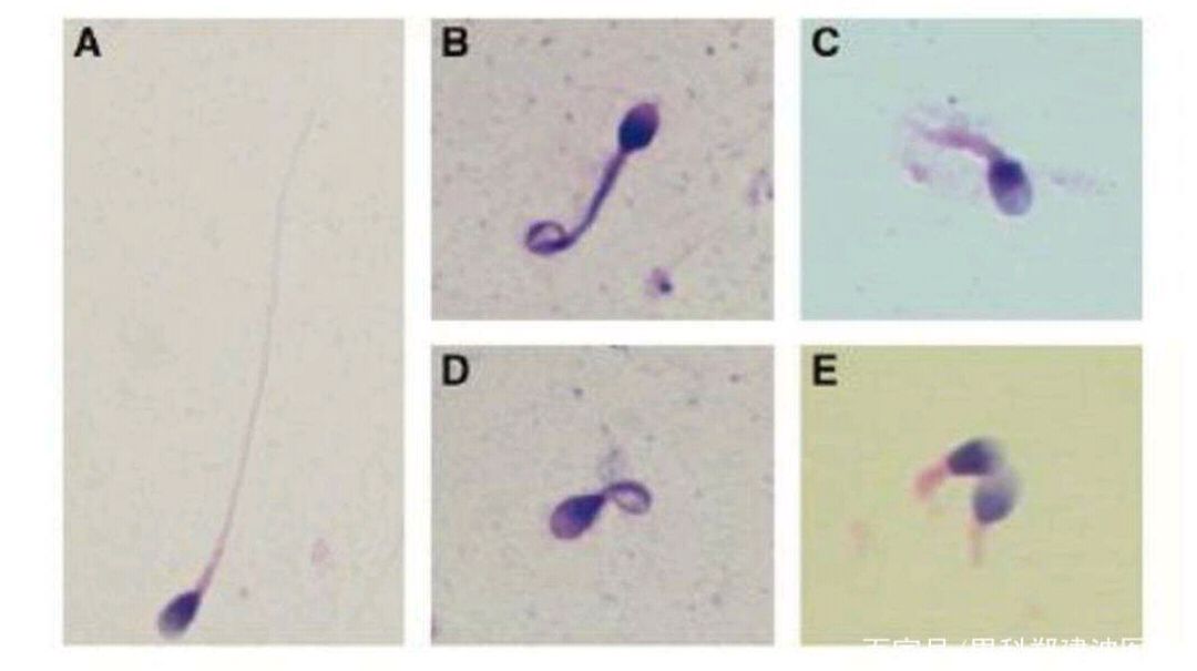畸形精子症怎么治疗有效,精子畸形症怎么治疗