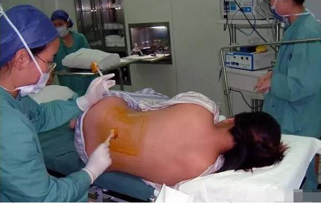 90后妈妈分享自己的剖腹产经历,产妇剖腹产真实经历