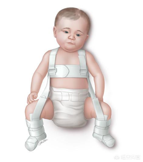 儿童发育性髋脱位表现,发育性髋关节脱位治疗4-7岁