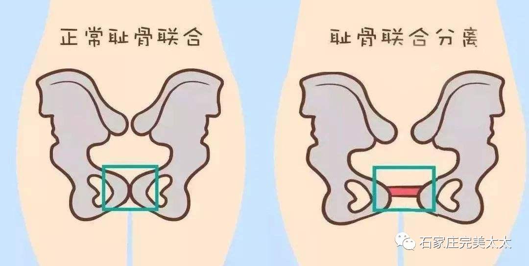 骨盆修复是产后宝妈必做项目,产后宝妈骨盆修复怎么做