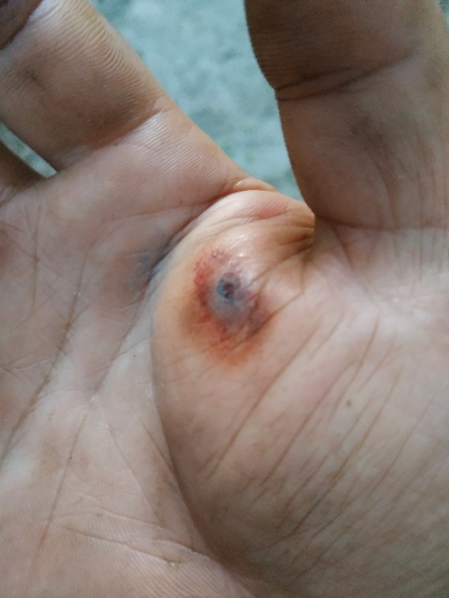 手受伤后，附近血管感觉有些堵塞，摸起来有个小包，这是怎么回事