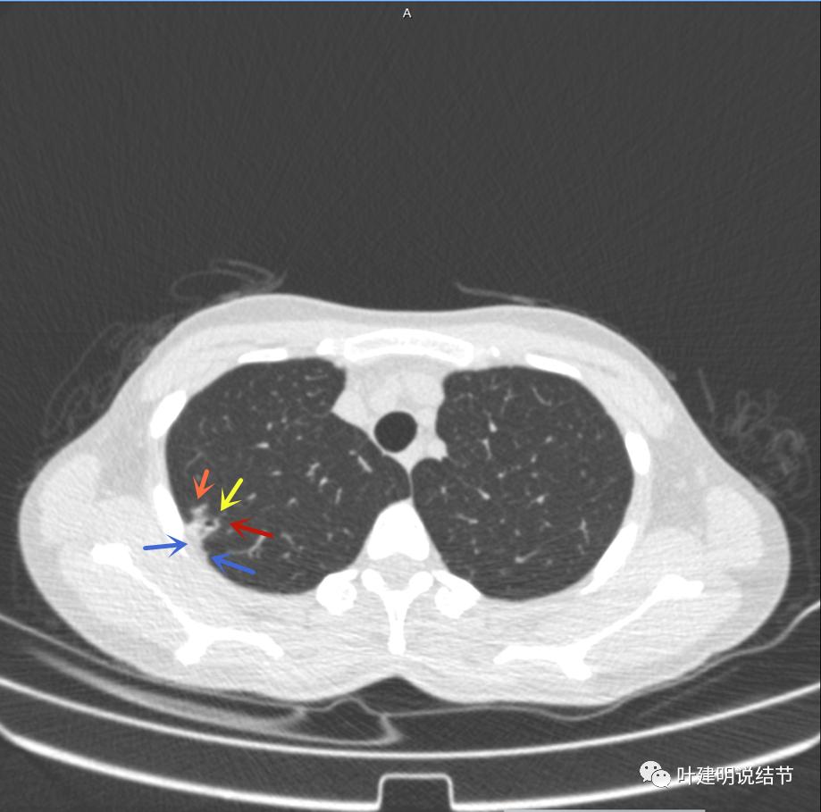 临床诊断孤立性肺结节,空洞型结节一般是什么性质