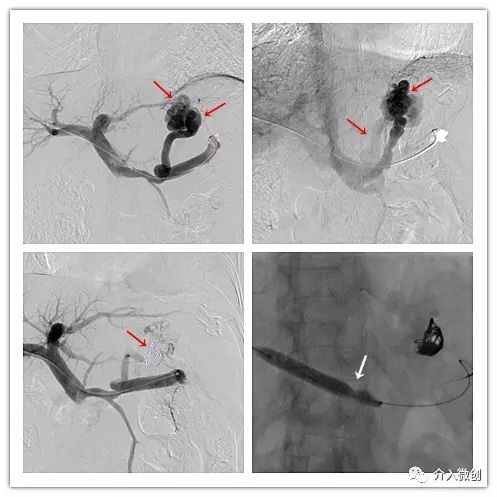 门静脉高压介入治疗好吗,缓解门静脉高压微创手术