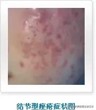 痘痘十大真相,痘痘大全图解