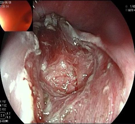 贲门处见隆起性病变,贲门高级别瘤变esd术后不能吃什么