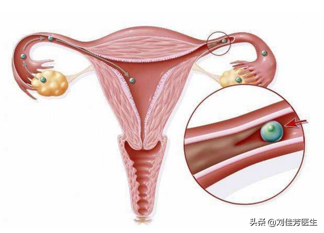 疏通输卵管堵塞的最佳时间和方法,出现输卵管堵塞怎么疏通最快