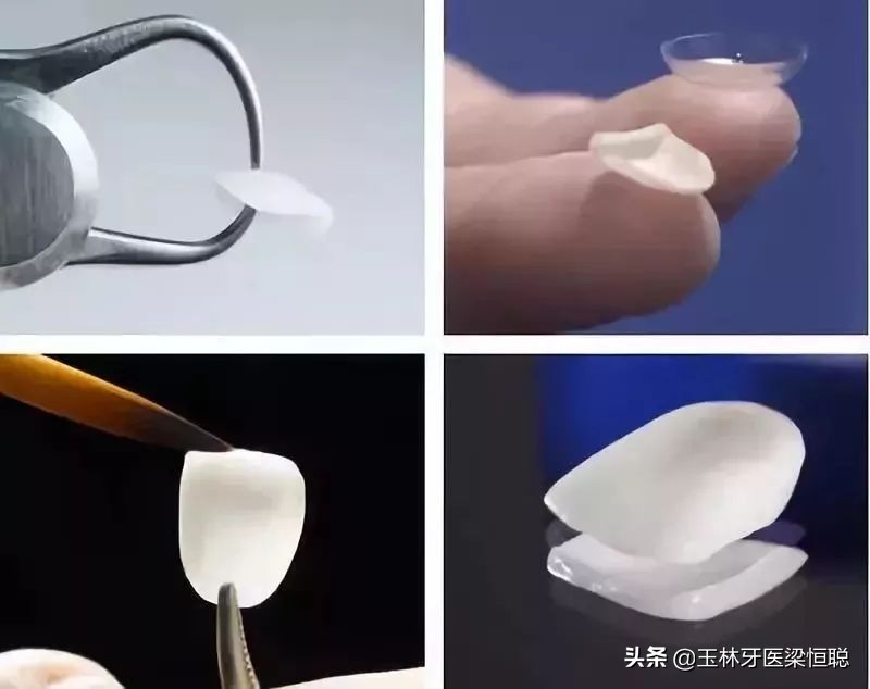 门牙缺损瓷贴面,牙缝大牙齿瓷贴面步骤全过程