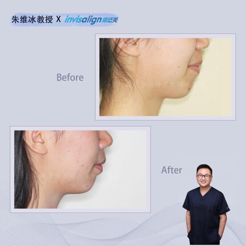 隐适美牙齿拥挤矫正真实案例,南京朱维冰