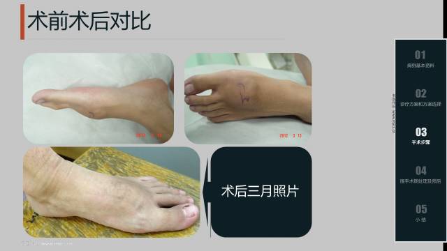 左侧颞窝动静脉畸形介入栓塞术,动静脉畸形介入栓塞后偏瘫