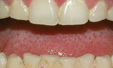 口腔溃疡是不是疱疹性口腔炎,口腔的常见20种疾病及治疗方法