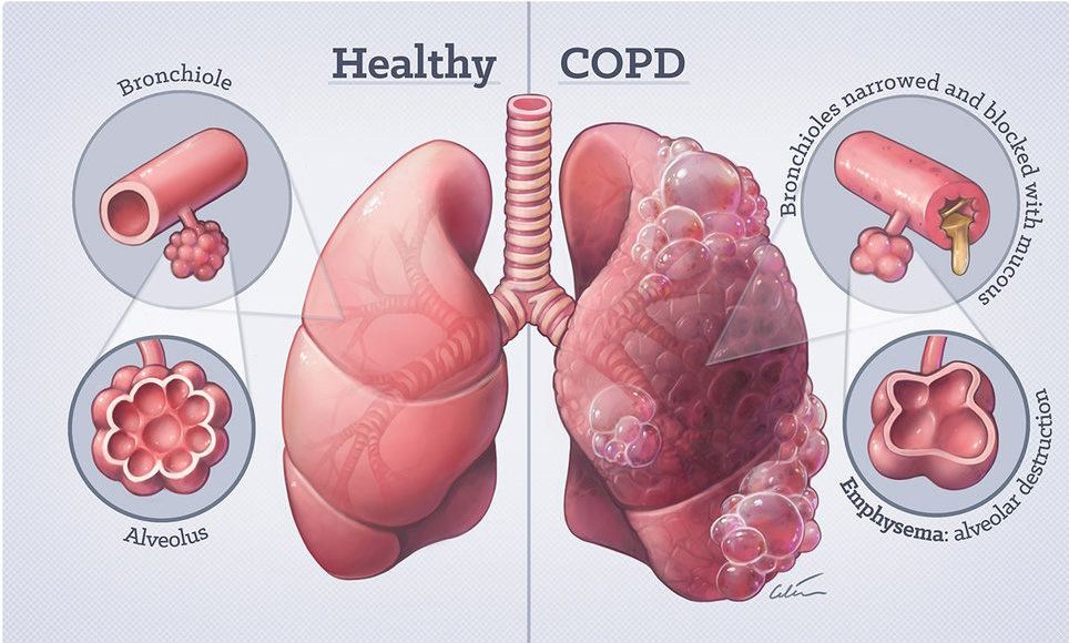慢阻肺二型呼吸衰竭是重大疾病吗,慢阻肺早期呼吸衰竭是几型