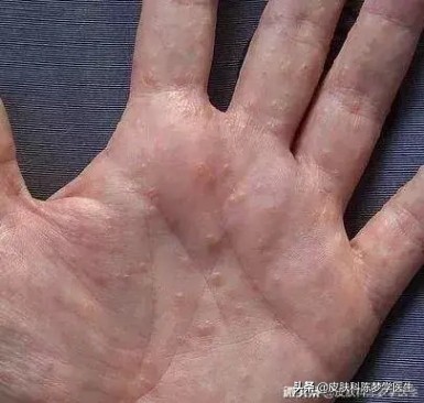 手上出水泡全身瘙痒,手上瘙痒起小水泡怎么回事