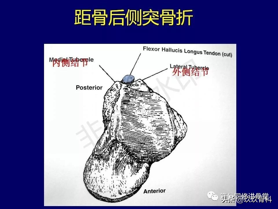 距骨骨折后遗症,距骨骨折怎么办