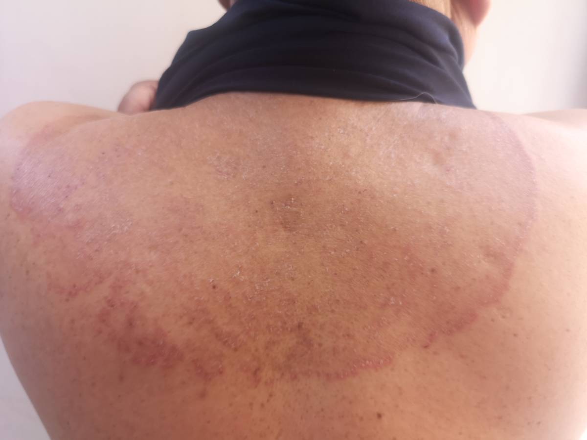 远离真菌感染,夏天常见的皮肤真菌病