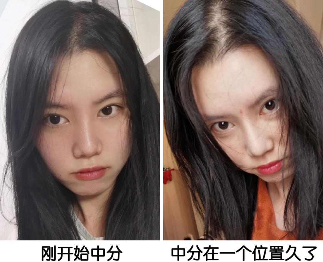 颅顶高了但发际线高怎么办,颅顶低的几种补救办法