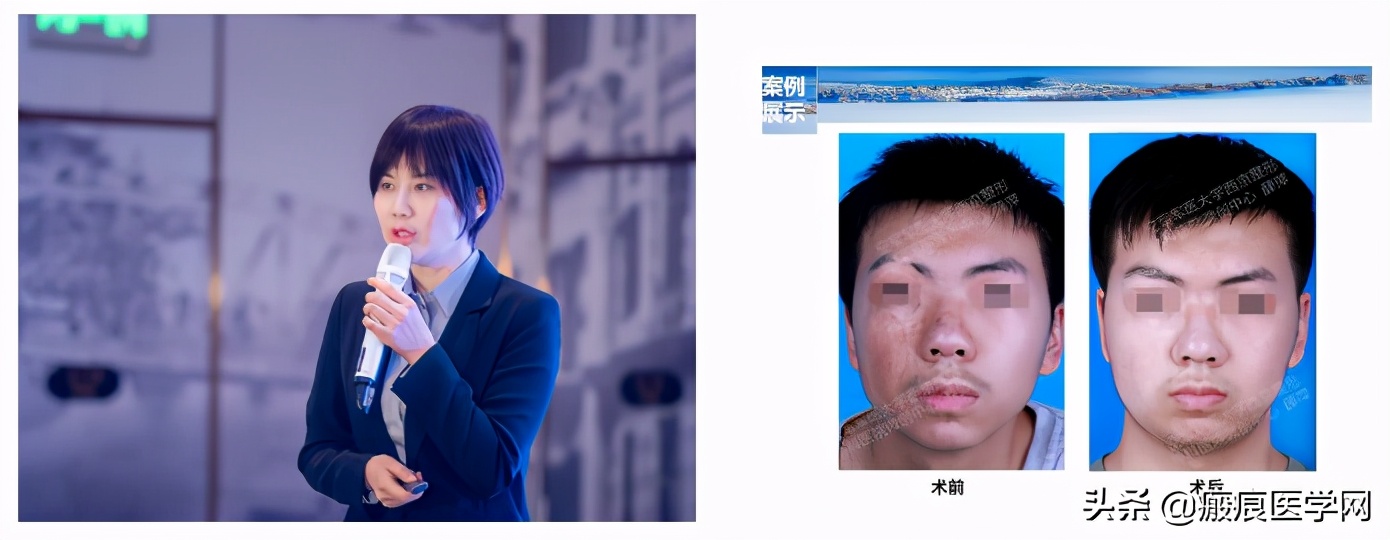 鐦㈢棔妗堜緥,鐤ょ棔娌荤枟鎴愬姛妗堜緥