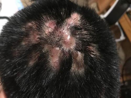 毛囊闭锁三联症怎么彻底治疗,毛囊闭锁三联征北京哪里可以治