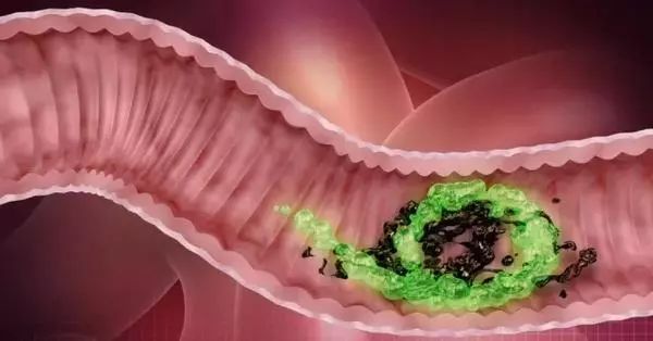 这种息肉，十有八九会癌变！医生呼吁：千万别小病拖成大病