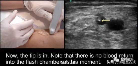超声引导下血管穿刺效果评价,超声引导下血管穿刺置管流程