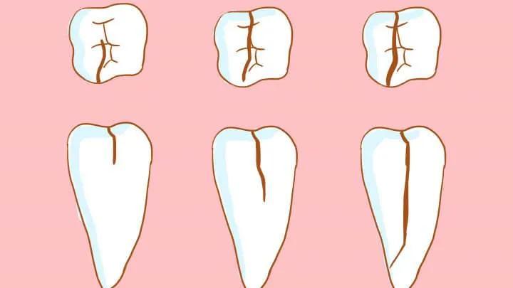 什么情况要做根管治疗,根管治疗是怎么样一个过程