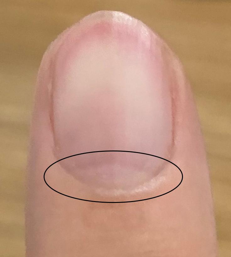 指甲问题对应身体哪里有问题,指甲的各种病变及解决办法