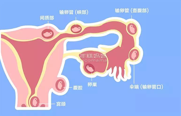 比意外怀孕更可怕的，就是宫外怀孕了