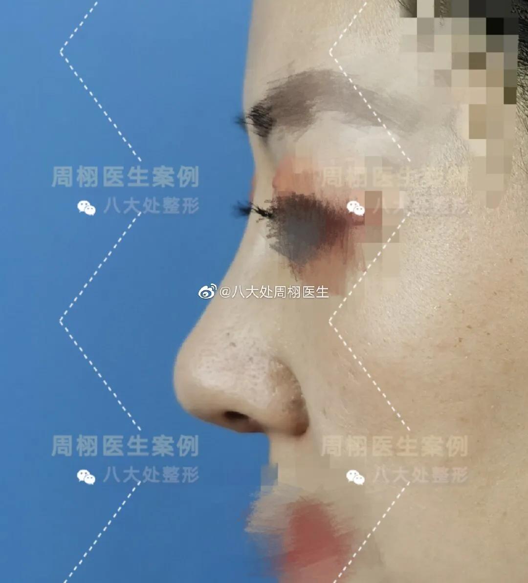 鼻整形手术,鼻整形术