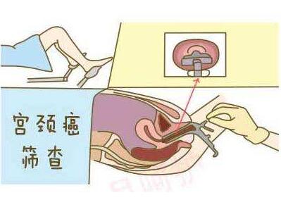 不同年龄段女性容易得宫颈癌吗,年龄较小患上宫颈癌可能性大吗