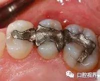 补牙材料银汞合金对身体有害吗,补牙银汞合金是膨胀材料吗