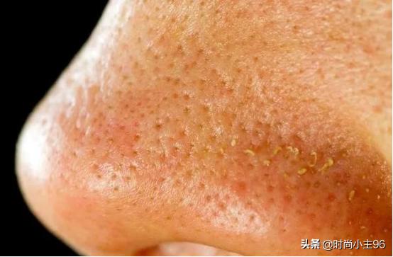 肌肤毛孔粗大出油,油性皮肤毛孔大怎么办