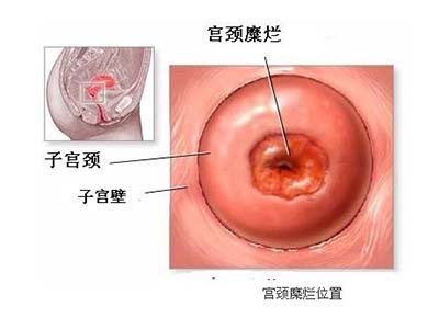 得了宫颈糜烂不治,宫颈糜烂不治会得宫颈癌吗