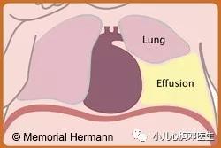 胎儿胸腔积液怎么办,36周胎儿胸腔积液