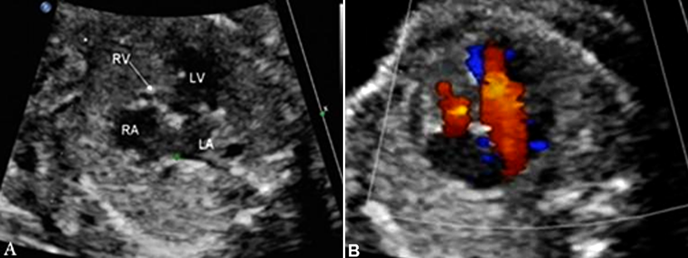 明明白白做超声26-4：胎儿心脏解剖结构异常-心室发育异常