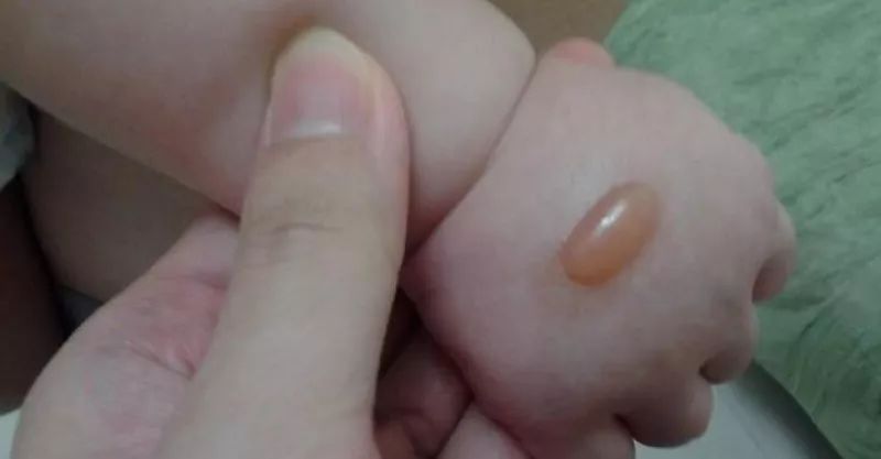 女童抠破“小红疙瘩”致下肢坏死，3次手术保命！医生：出现这些症状别不在意